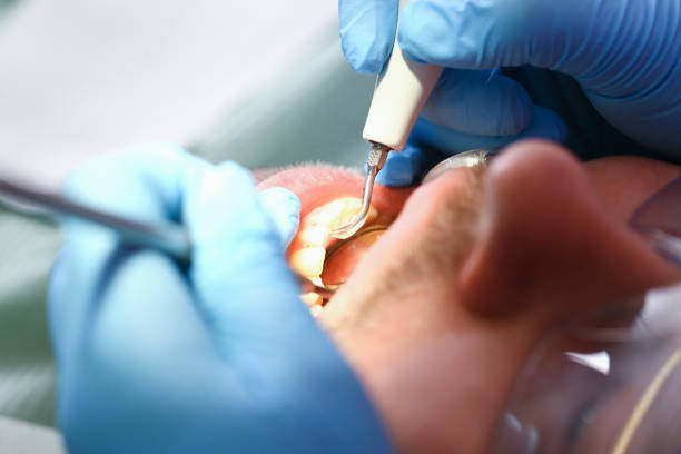 Best Emergency Root Canal Treatment in Glandorf, OH